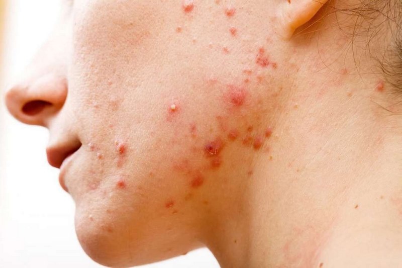 Tại sao da mặt lại không trắng? 