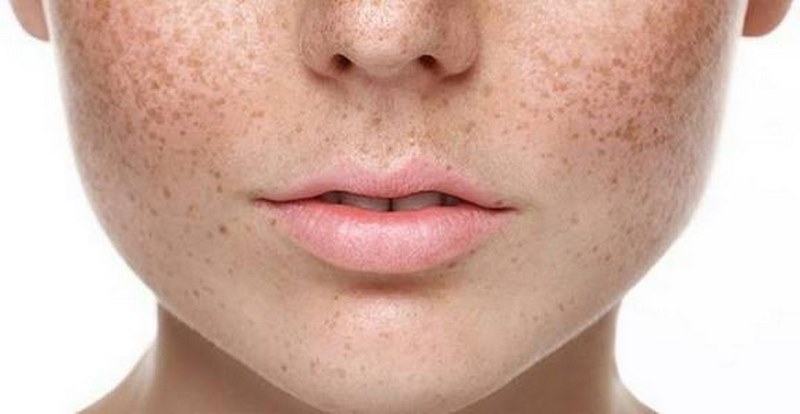 Biểu hiện của làn da bị vấn đề nám nắng