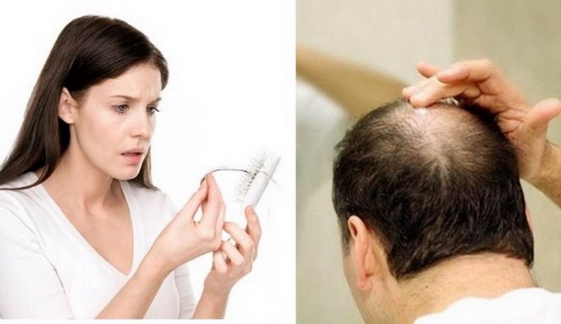 Rụng tóc mang đến nỗi lo cho cả nam và nữ